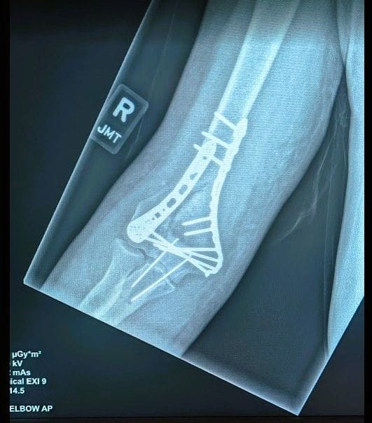 Front view X-ray of my right elbow after the surgery. From FoxRVTravel My crash landing in London.