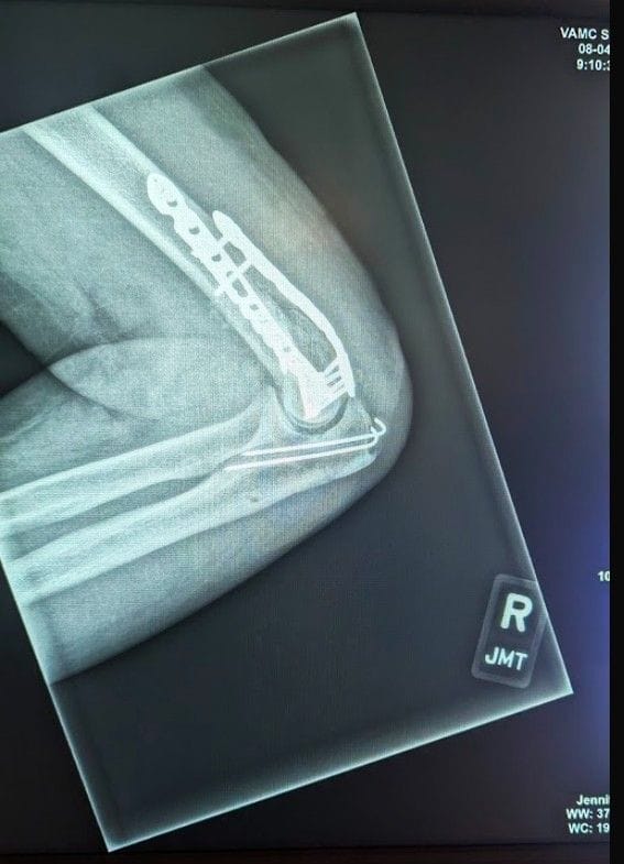 X-Ray of my right elbow after the surgery. From FoxRVTravel My crash landing in London.