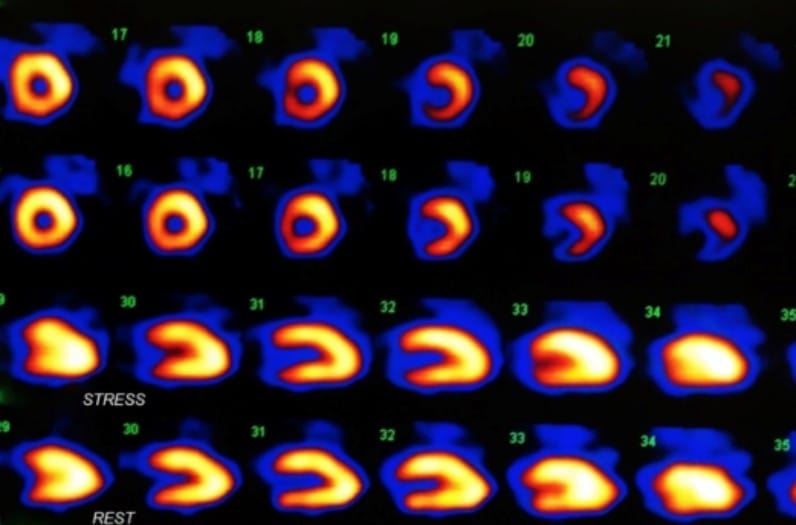 Image from Beverly Hills Cardiovascular image from a nuclear stress test.