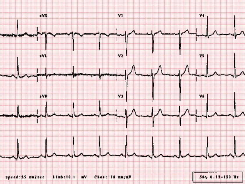 Image from John Hopkins College of an ECG.