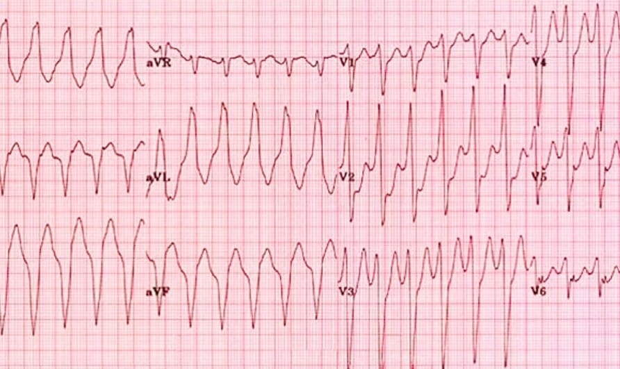 Image of an ECG from Stenberg College. I assume this is an abnormal ECG.